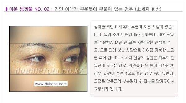 [두한성형외과 경쟁력 눈성형] - [미운 쌍꺼풀이란?] 관련 이미지 3