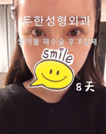 [두한성형외과 쌍커풀재수술] - [쌍수흉터] 관련 이미지 4