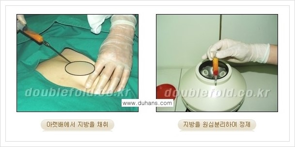 [두한성형외과 경쟁력 눈성형] - [미세지방이식으로 두껍고 어색한 라인 교정 안내 1.] 관련 이미지 2