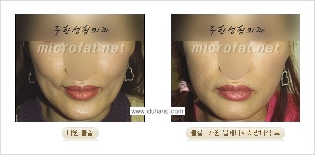 ⁠[두한성형외과 경쟁력 미세지방이식] - [상표등록 "Col-fat(콜펫) 지방이식"으로 교정이 가능한 부위] 관련 이미지 9