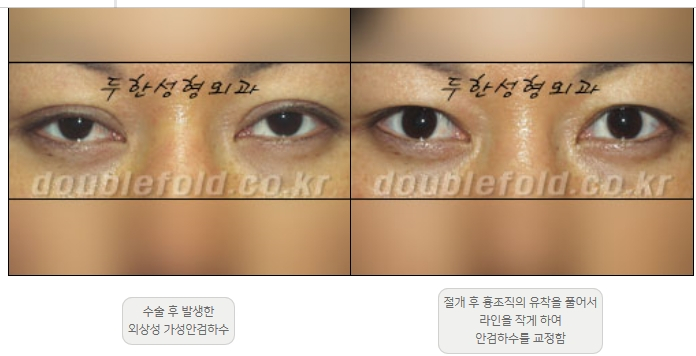 [Ptosis, Duhan Plastic Surgery] - [Sleepy-Looking Eyes, Ptosis Eye Correction] image 6