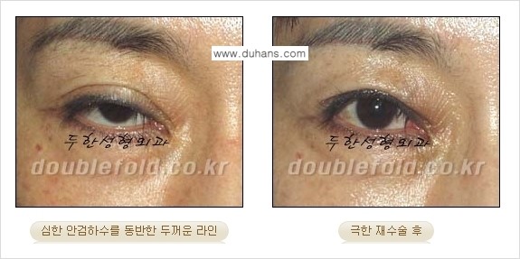 [두한성형외과 경쟁력 쌍꺼풀 재수술] - [망가진 쌍꺼풀 라인을 교정하는 극한재수술 ①] 관련 이미지 8
