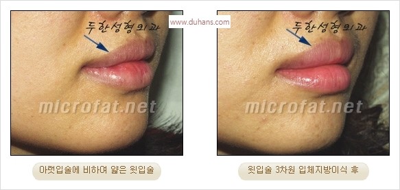 ​​[두한성형외과 경쟁력 미세지방이식] - [볼륨감 있는 입술성형] 관련 이미지 16