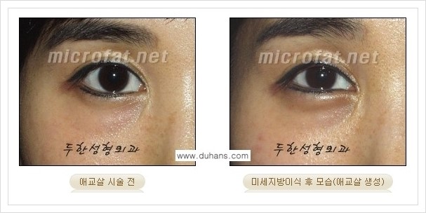 [두한성형외과 경쟁력 눈밑성형] - [눈밑 애교살 미세지방이식 안내] 관련 이미지 10
