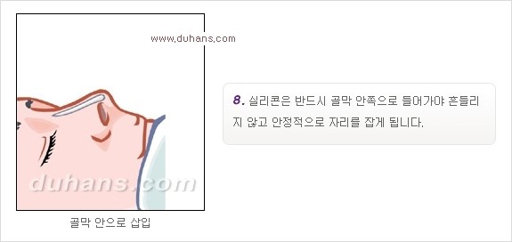 [두한성형외과 경쟁력 코성형] - [코성형을 위한 알로덤(슈어덤) 수술, 실리콘 수술 안내] 관련 이미지 25