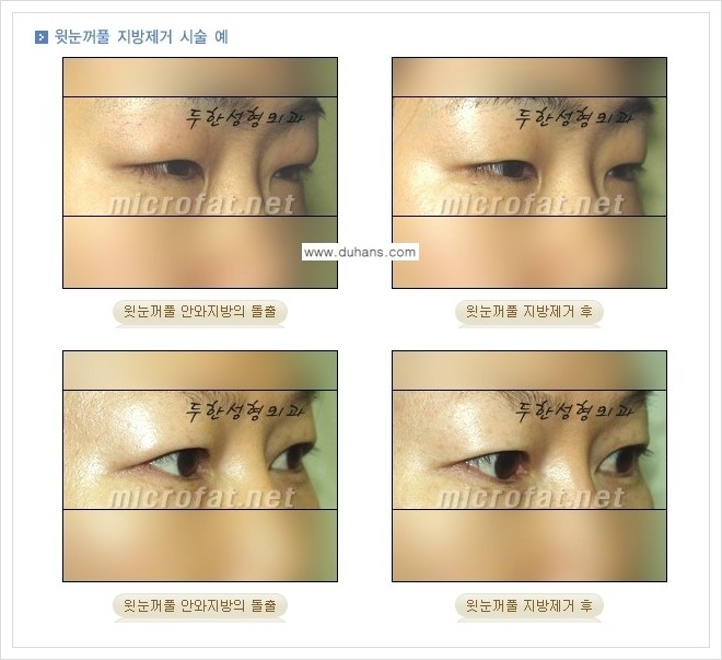 [두한성형외과 경쟁력 지방제거] - [눈밑지방제거, 눈위(윗눈꺼풀)지방제거 안내] 관련 이미지 12