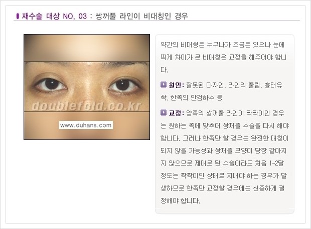 ⁠⁠[두한성형외과 경쟁력 쌍꺼풀 재수술, 극한 재수술] - [쌍꺼풀 재수술이 필요한 경우 안내] 관련 이미지 4