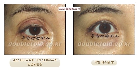 [두한성형외과 경쟁력 쌍꺼풀 재수술] - [두꺼운 라인을 교정하는 극한 재수술(Extreme Rroperation)] 관련 이미지 8