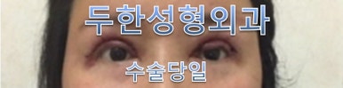 [Duhan Plastic Surgery Double Eyelid Revision] - [Reducing the Double Eyelid Line] image 17