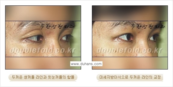[두한성형외과 NO.1 눈성형] - [함몰된(꺼진) 눈꺼풀에서 쌍꺼풀 라인 교정 2.] 관련 이미지 16