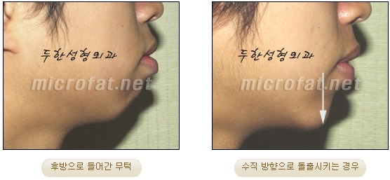 [두한성형외과 미세지방이식] - [무턱교정 안내] 관련 이미지 6