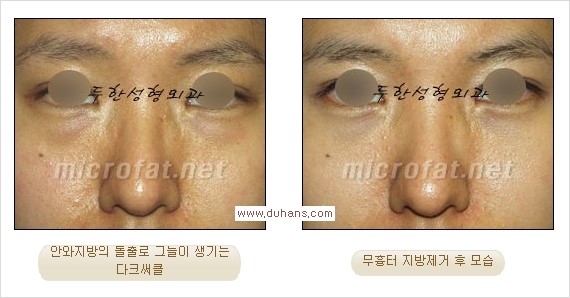 [두한성형외과 경쟁력 눈밑성형] - [과도한 눈밑지방제거의 부작용 후 눈밑지방재배치] 관련 이미지 9