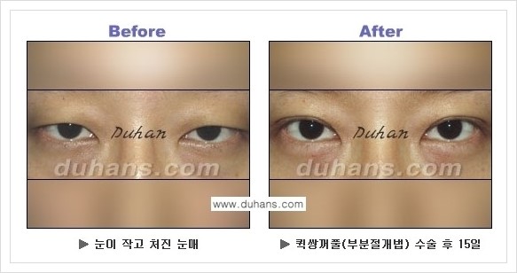 [두한성형외과 경쟁력 눈성형] - [퀵쌍꺼풀 수술 전후 정보 안내 ②] 관련 이미지 8