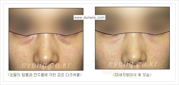 [두한성형외과 경쟁력 눈밑성형] - [다크써클 수술 안내 2.] 관련 이미지 8