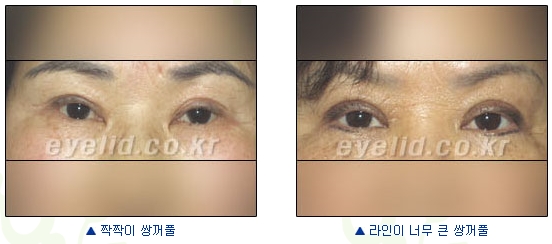 Duhan Plastic Surgery Eye Surgery - Are You a Candidate for Double Eyelid Revision Surgery?! image 2