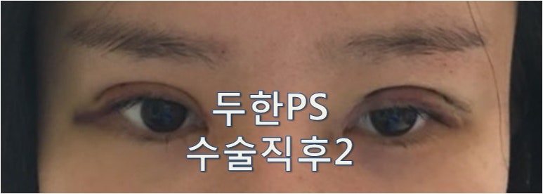[두한성형외과 쌍꺼풀재수술]-[#라인키우기 #비대칭 #낮은라인 #울퉁불퉁 #짝눈] 관련 이미지 3