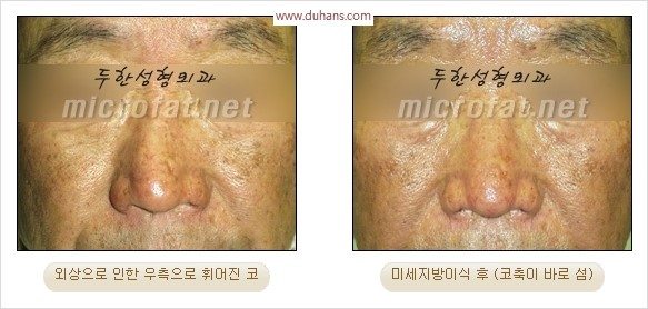 [두한성형외과 경쟁력 코성형 리더] - [자연스럽고 오똑한 콧망울! 코성형 방법]​ 관련 이미지 53