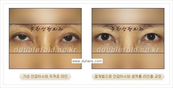 [두한성형외과 경쟁력 쌍꺼풀 재수술, 극한 눈 재수술] - [안검하수(졸리운 눈매) 재수술 안내] 관련 이미지 9