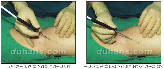 [두한성형외과 종아리 퇴축] - [종아리 퇴축술 재발 재수술] 관련 이미지 11