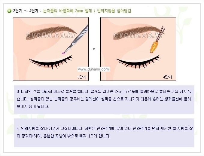 [두한성형외과 경쟁력 지방제거] - [윗눈꺼풀 지방제거, 아랫 눈꺼풀 지방제거  안내 1.] 관련 이미지 7