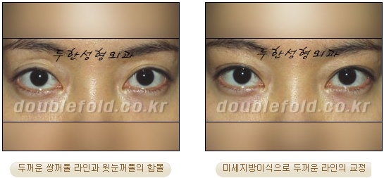 [Eye Reoperation Duhan Plastic Surgery] - [Guide to Double Eyelid Revision Surgery] image 49