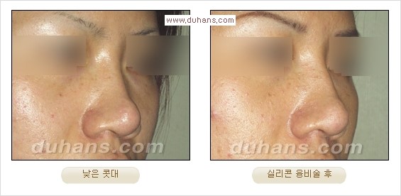 [두한성형외과 경쟁력 코성형] - [코성형을 위한 알로덤(슈어덤) 수술, 실리콘 수술 안내] 관련 이미지 28
