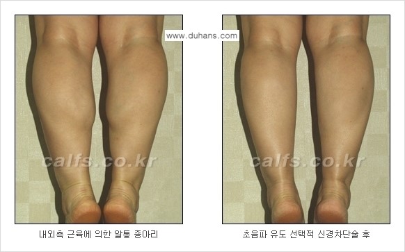 [두한성형외과 경쟁력 종아리성형] - [초음파 유도 선택적 신경차단술 안내 ③] 관련 이미지 7