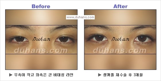 [두한성형외과 경쟁력 눈성형] - [Dr. 컬럼  "어떤 쌍꺼풀이 아름다운 쌍꺼풀인가?!] 관련 이미지 12