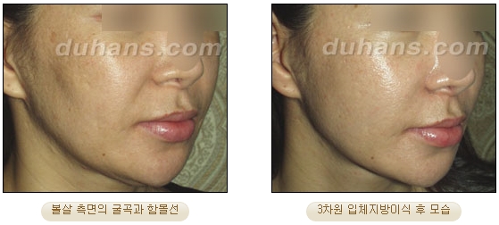 [두한성형외과 얼굴자가지방이식] - [볼살, 이마, 측두부] 관련 이미지 24