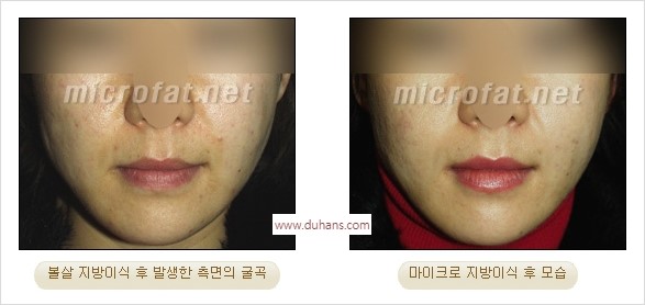 [두한성형외과 경쟁력 미세지방이식] - [지방이식 부작용 교정 모습 안내] 관련 이미지 16