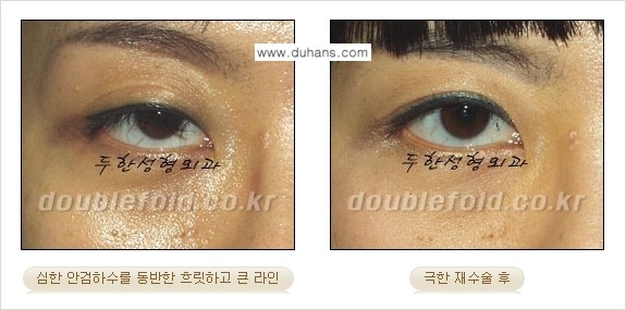 [두한성형외과 경쟁력 눈성형] - [재수술시 유의해야 할 사항과 성공 요건] 관련 이미지 8