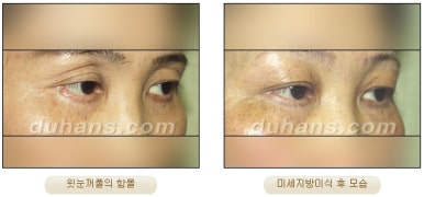 [Duhan Plastic Surgery Micro Fat Grafting] - [Upper Eyelids] image 7