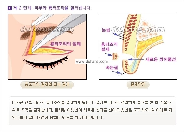 [두한성형외과 경쟁력 눈성형] - [쌍꺼풀 재수술 방법 - 완전절개법(Full incision method) 과정 안내] 관련 이미지 3