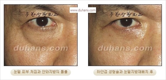 [두한성형외과 경쟁력 안검성형] - [눈밑주름 제거수술] 관련 이미지 5