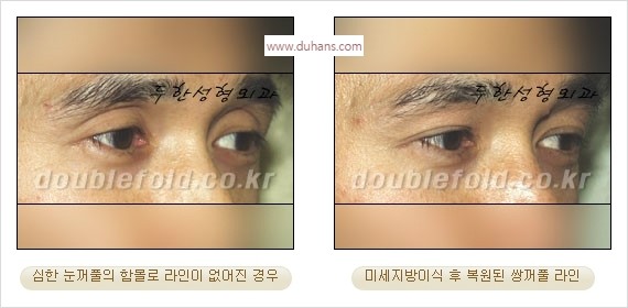 [두한성형외과 경쟁력 눈성형] - [나에게 맞는 어울리는 쌍꺼풀 라인] 관련 이미지 66