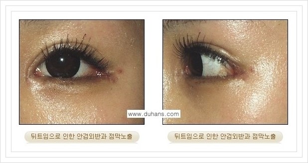 [두한성형외과 경쟁력 쌍꺼풀 재수술, 극한 재수술] - [뒤트임 수술에 대한 안내] 관련 이미지 7
