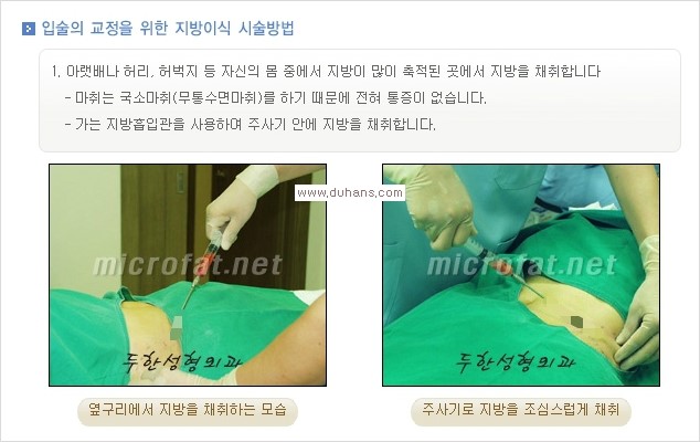 [두한성형외과 경쟁력 미세지방이식] - [입체 미세지방이식으로 주름을 펴면서 볼륨감 있는 입술 만들기] 관련 이미지 2