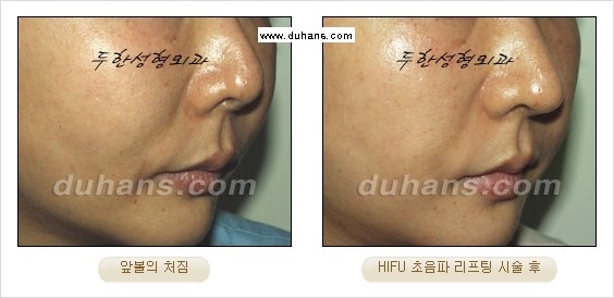 [두한성형외과 경쟁력 주름성형] - [주름제거를 위한 리프팅] 관련 이미지 50