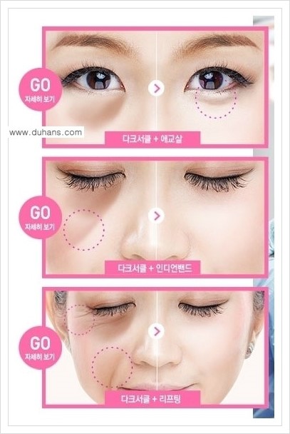 [두한성형외과 경쟁력 다크써클 교정] - [다크써클 5단계로 이뤄지는 핵심 5 STEP SOLUTION 안내 2.] 관련 이미지 2