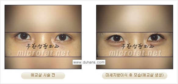 [두한성형외과 경쟁력 눈밑성형] - [눈밑 다크써클과 눈밑 애교살과의 관계 1.] 관련 이미지 7