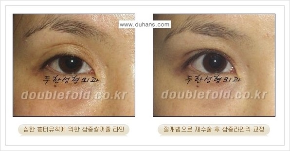 [두한성형외과 경쟁력 쌍꺼풀 재수술] - [삼중 쌍꺼풀 라인의 교정 안내] 관련 이미지 3