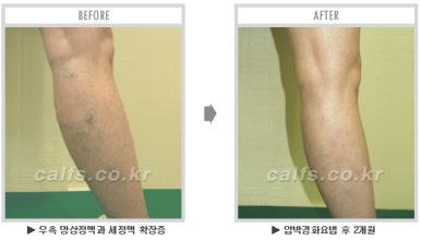​[두한성형외과 종아리수술] - [나에게 맞는 종아리성형방법] 관련 이미지 51