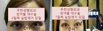 [Ptosis, Duhan Plastic Surgery] - [Sleepy-Looking Eyes, Ptosis Eye Correction] image 27
