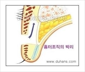 [두한성형외과 경쟁력 쌍꺼풀 재수술, 극한 눈재수술] - [쌍꺼풀 재수술, 눈재수술 실패의 원인 안내] 관련 이미지 3