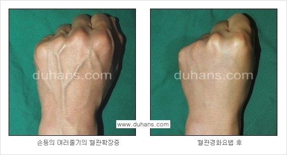 [두한성형외과 정맥 혈관 확장으로 인한 피부개선] - [손, 팔 혈관 확장] 관련 이미지 13