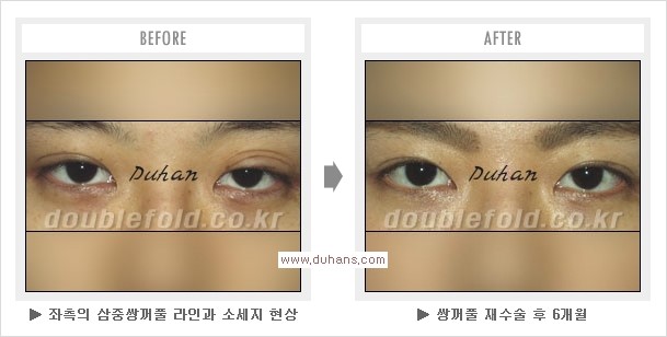 [두한성형외과 경쟁력 눈성형] - [쌍꺼풀 재수술 대상과 쌍꺼풀 재수술에 필요한 검사와 테스트] 관련 이미지 32