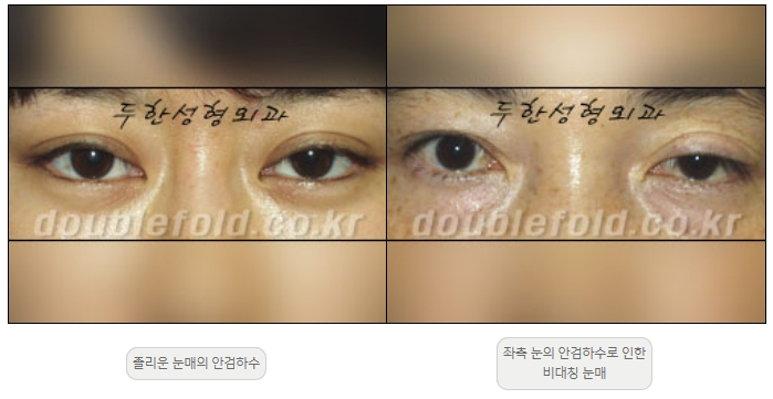 [Ptosis, Duhan Plastic Surgery] - [Sleepy-Looking Eyes, Ptosis Eye Correction] image 1