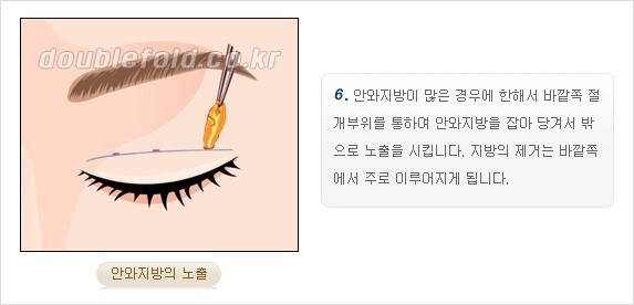 [두한성형외과 경쟁력 쌍꺼풀 재수술, 극한 재수술] - [쌍꺼풀 재수술의 과정 안내 2.] 관련 이미지 9