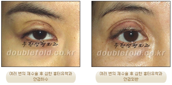 [두한성형외과 쌍수재수술] - [눈재수술에 대한 최선에 대안] 관련 이미지 31