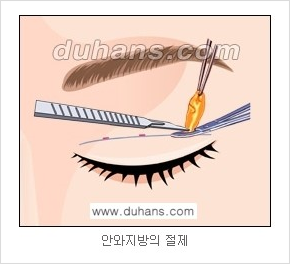 ​[두한성형외과 경쟁력 눈성형] - [자연스러운면서 매력적인 쌍꺼풀 퀵 쌍꺼풀 수술 안내] 관련 이미지 10